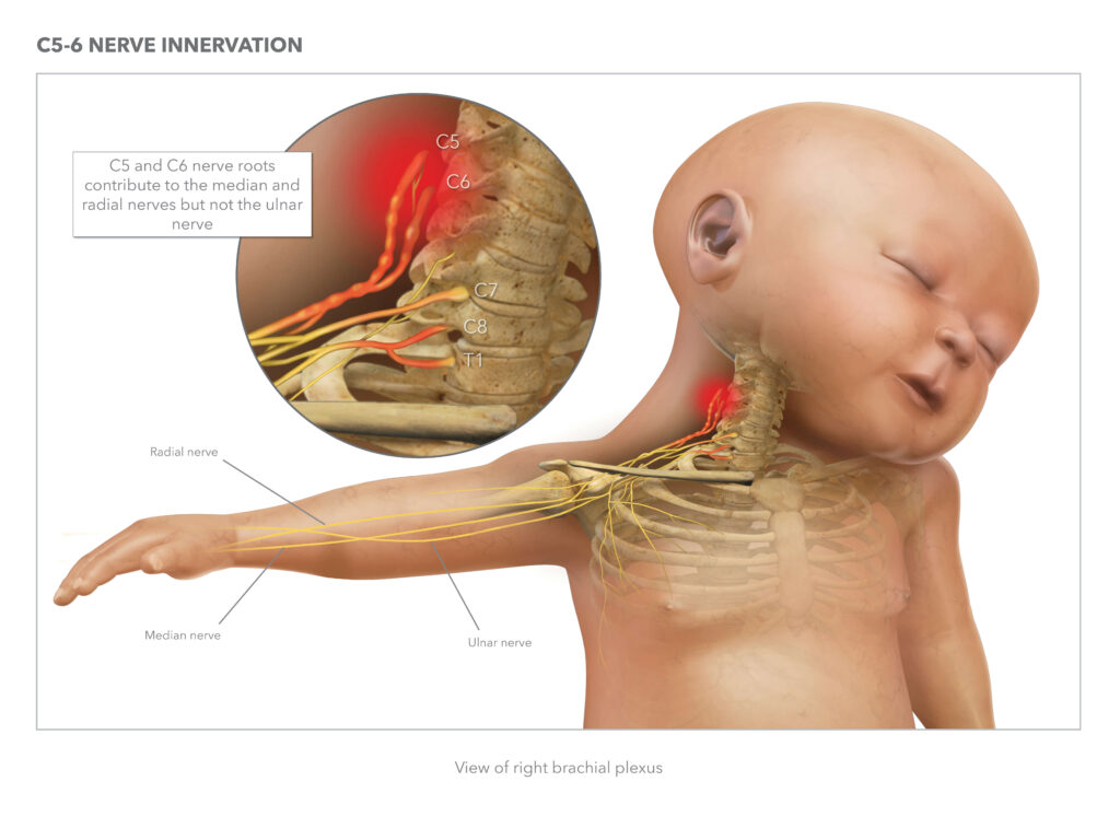 Brachial Plexus Injury Cause