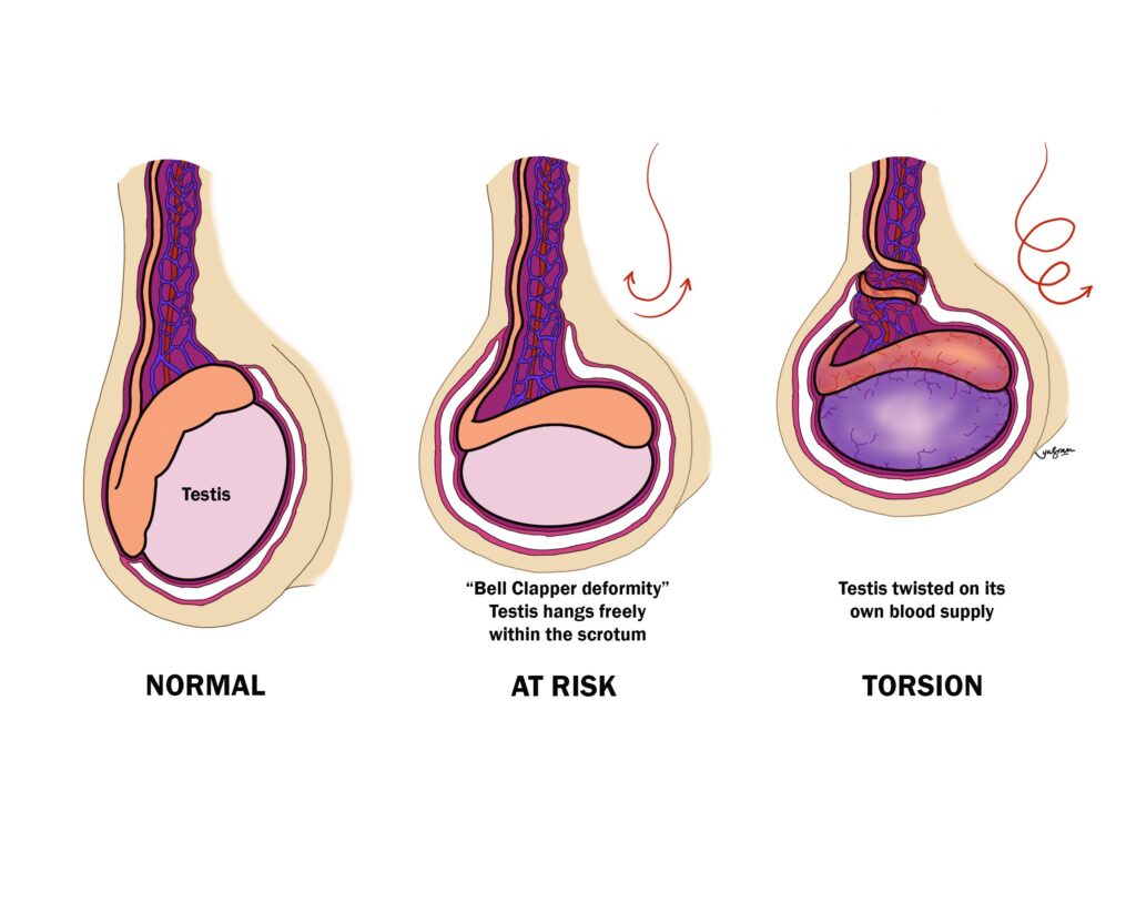 Testicular torsion is a severe condition that occurs when the spermatic cord, which supplies blood to the testicle, twists and cuts off blood flow. The result is extreme pain, swelling, and, without immediate medical intervention, permanent damage or loss of the testicle. This is a medical emergency requiring urgent surgical treatment to untwist the spermatic cord and restore blood flow.