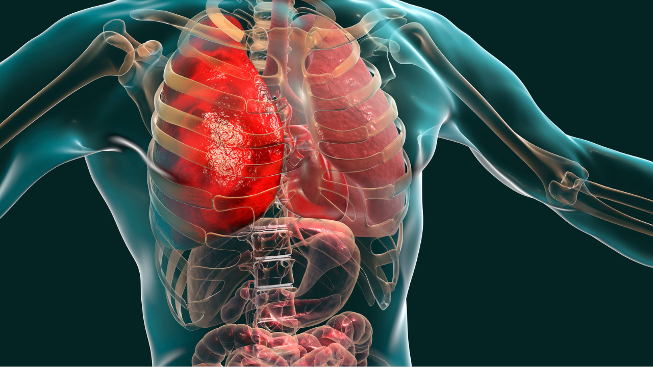 Several factors can increase a patient’s risk of developing a pulmonary embolism. Among the most common causes are: