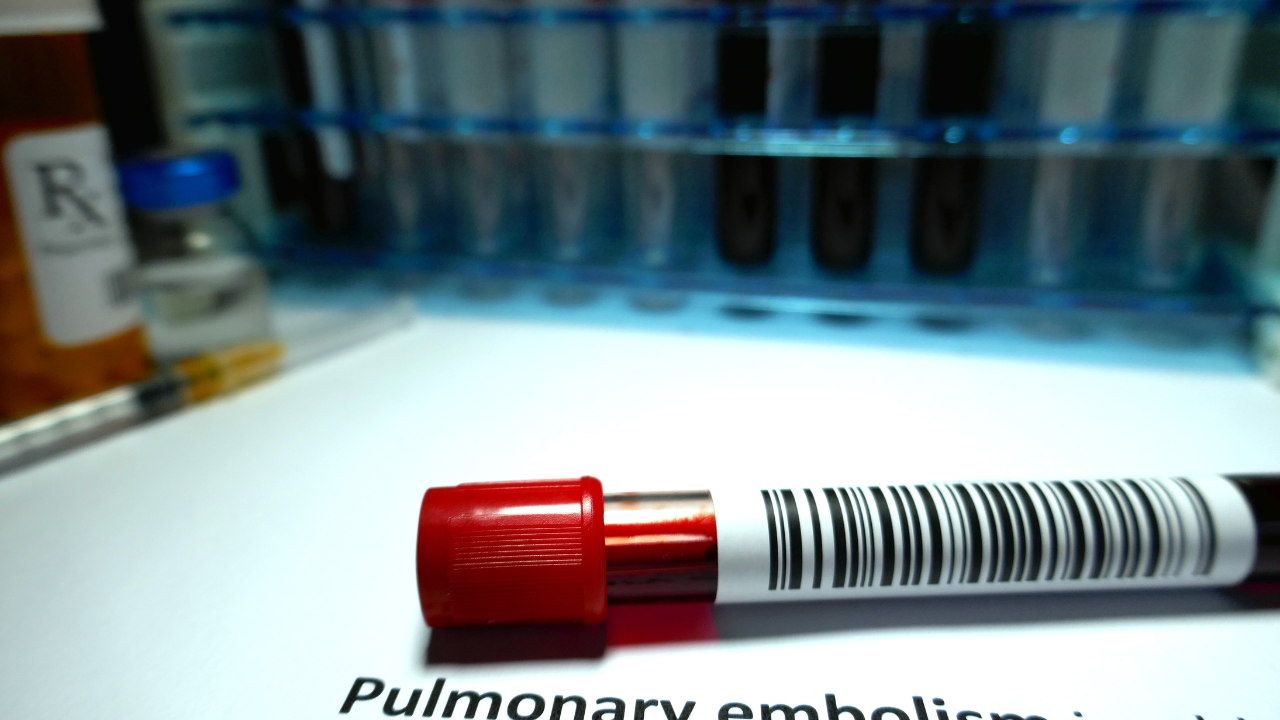 Medical malpractice in pulmonary embolism cases arises when healthcare providers fail to meet the standard of care expected under similar circumstances. Common examples of medical negligence in PE cases include: