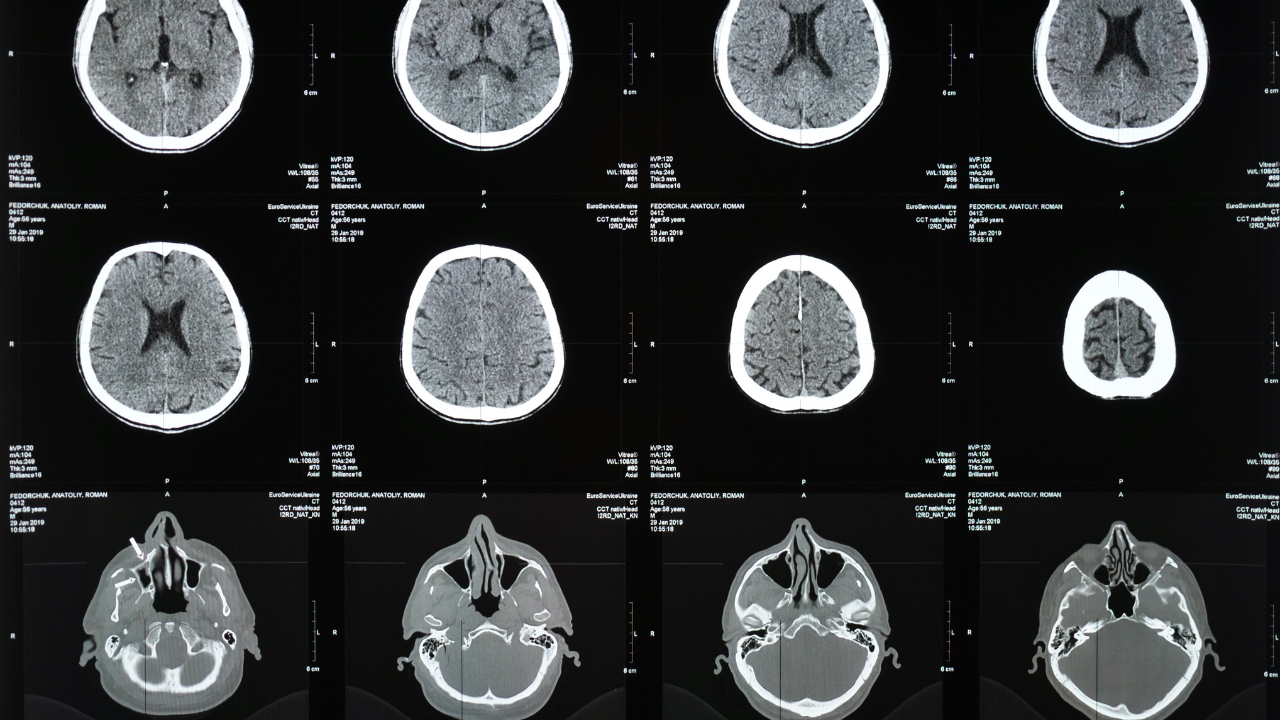 Radiologists, like all healthcare professionals, owe a duty of care to their patients. When they breach this duty—whether through negligence or miscommunication—the consequences can be devastating. In Florida, medical malpractice laws allow victims of radiologist errors to seek compensation for both economic and non-economic damages. Working with an Orlando radiologist error attorney can make the legal process smoother, as they navigate these complexities on your behalf.